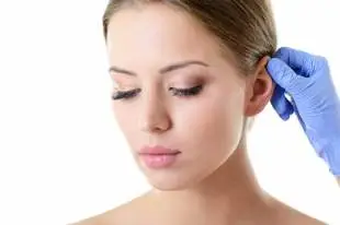 Kepçe kulak estetiği sonrası doğal kulak görünümü – otoplasti ameliyatı örneği