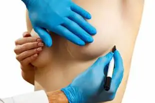 İstanbul’da meme küçültme ameliyatı - Dr. Hakkı İzmirli Klinik